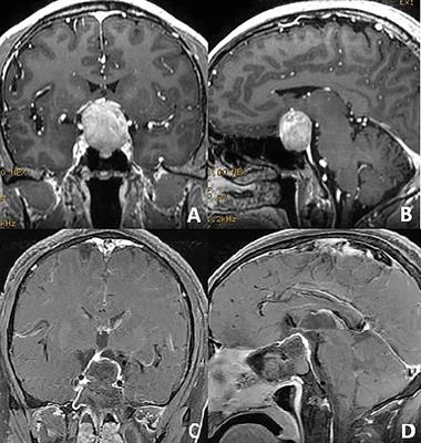 The Use of Micro <mark class="highlighted">Retractor</mark> in Endoscopic Endonasal Posterior Pseudocapsule Resection of Pituitary Macroadenoma. Technical Note